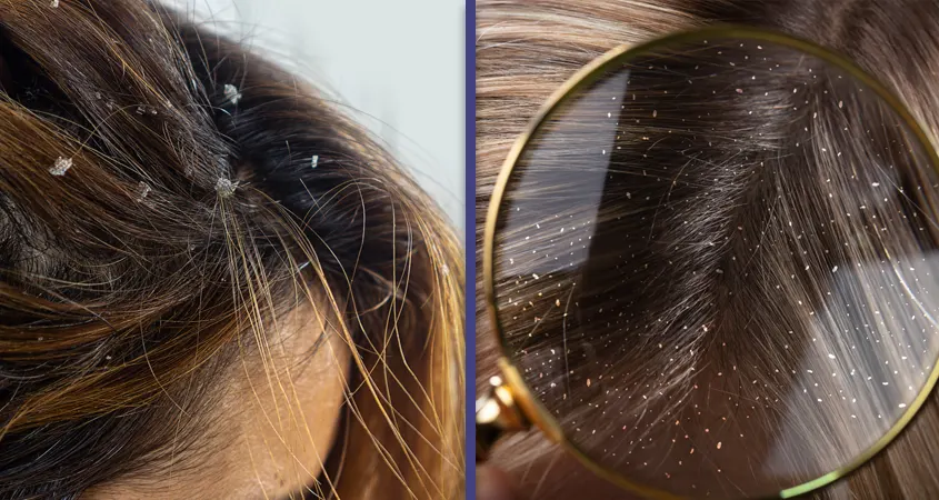 Dandruff