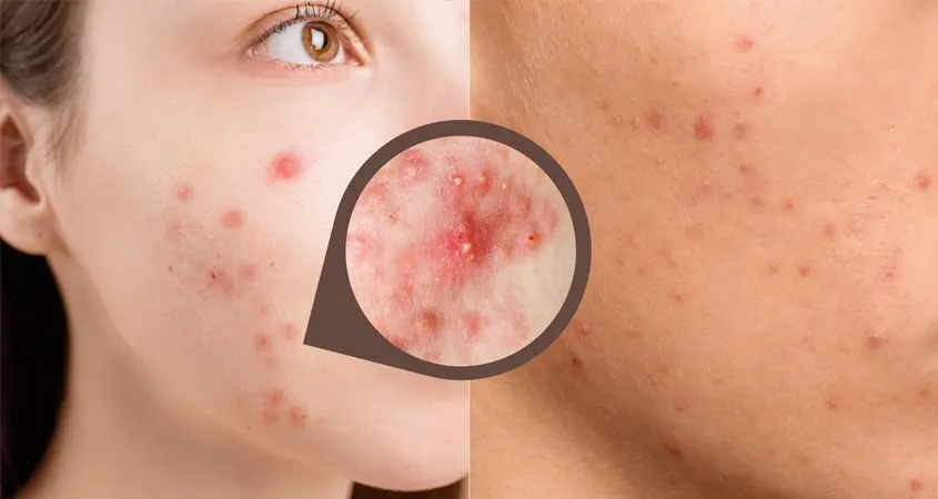 acne2
